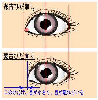 蒙古ヒダってどこでしょうか 目頭切開の手術と蒙古ヒダの関係 美容整形の名医相談所 失敗や口コミ