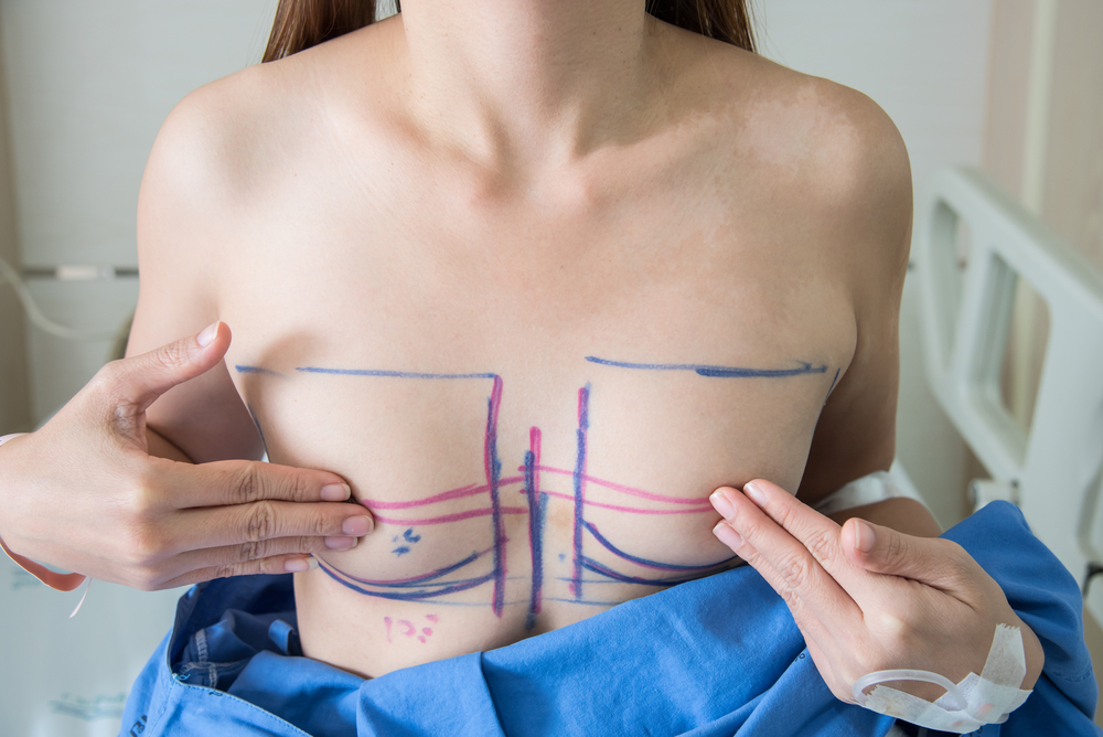 脂肪注入法による豊胸手術のアフターケア